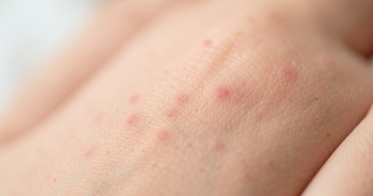 Dermatophilose : une IST venue des animaux ?